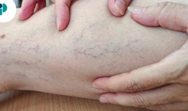 Várices: más que un problema estético, un riesgo circulatorio